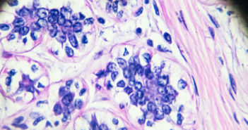 Improving Treatment for Triple-Negative Breast Cancer
