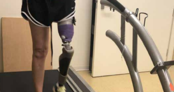 Novel Device Provides Continuous Monitoring of Skin, Prostheses