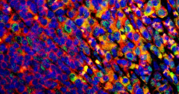 Novel Injectable Therapy Shows Promise in Treating Crohn’s Disease