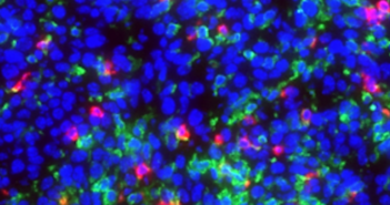 Northwestern Scientists Discover Potential Therapeutic Target for Glioblastoma