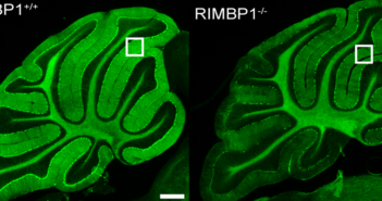 New Genetic Cause of Dystonia Revealed