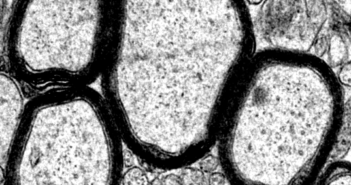 Inflammation Protection May Be Critical to Treating MS