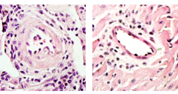 Immune Receptor Linked to Chronic Heart Transplant Rejection