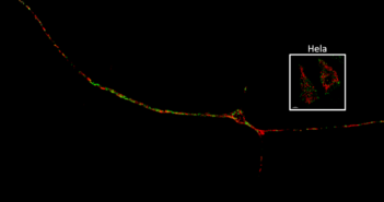 Interaction of Mitochondria and Lysosomes Key in Parkinson’s Disease