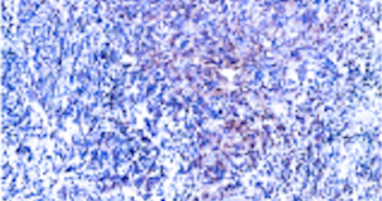 Protein Variant May Have Potential as Target for Glioblastoma