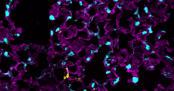 Transforming Lung Cells Critical for Pulmonary Fibrosis
