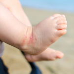 Wearable Sensor Tracks Pediatric Eczema, Adult Itch Symptoms