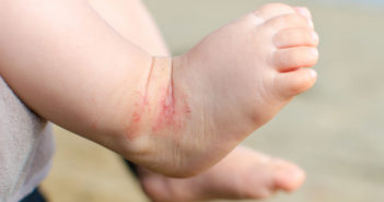 Wearable Sensor Tracks Pediatric Eczema, Adult Itch Symptoms
