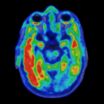 Biomarker Predicts Cognitive Decline in Alzheimer’s Disease