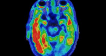 Biomarker Predicts Cognitive Decline in Alzheimer’s Disease