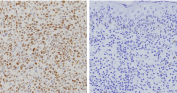 Skin Cancer Harbors Targetable Mutation
