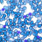 Advancing Treatment for B-cell Acute Lymphoblastic Leukemia