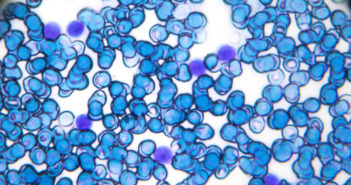 Advancing Treatment for B-cell Acute Lymphoblastic Leukemia
