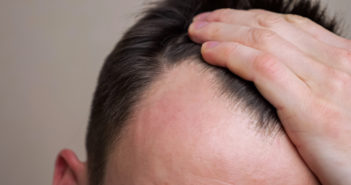 Of Balding Mice and Men and Women Young man examines his bald spots in the mirror