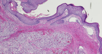 Study Identifies Expanded Role for Metabolic Enzyme in Kidney Cancer