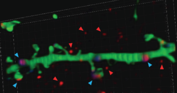 New Autism Biomarker Discovered in Cerebrospinal Fluid