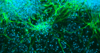 Histone Protein Influences Both Neurological Disorder and Cancer