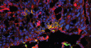Neural Stem Cell Therapy May Improve Metastatic Cancer Survival