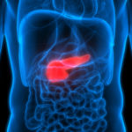 Investigators Identify Potential Therapeutic Target for Pancreatic Cancer